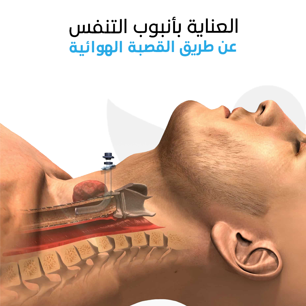 العناية بأنبوب التنفس عن طريق القصبة الهوائية – زيارة منزلية واحدة